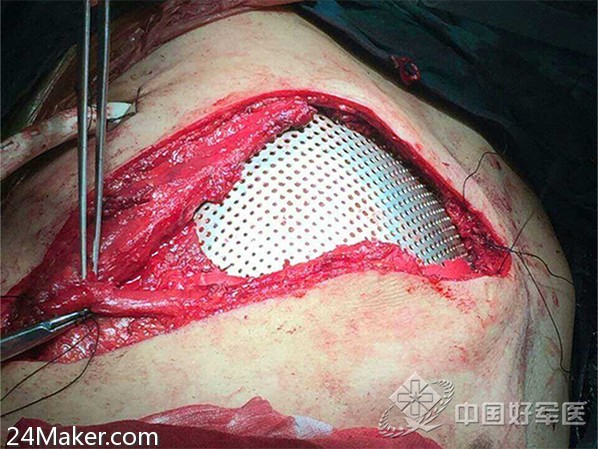 西南医院利用医学3d打印技术为患者重建胸壁